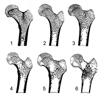 Légende :&nbsp;la raréfaction des travées osseuses s'observe avec l'avancement en âge  (1: individu jeune; 6: individu âgé)
Source : Luc Buchet, d'après Némeskéri et al. (1960)